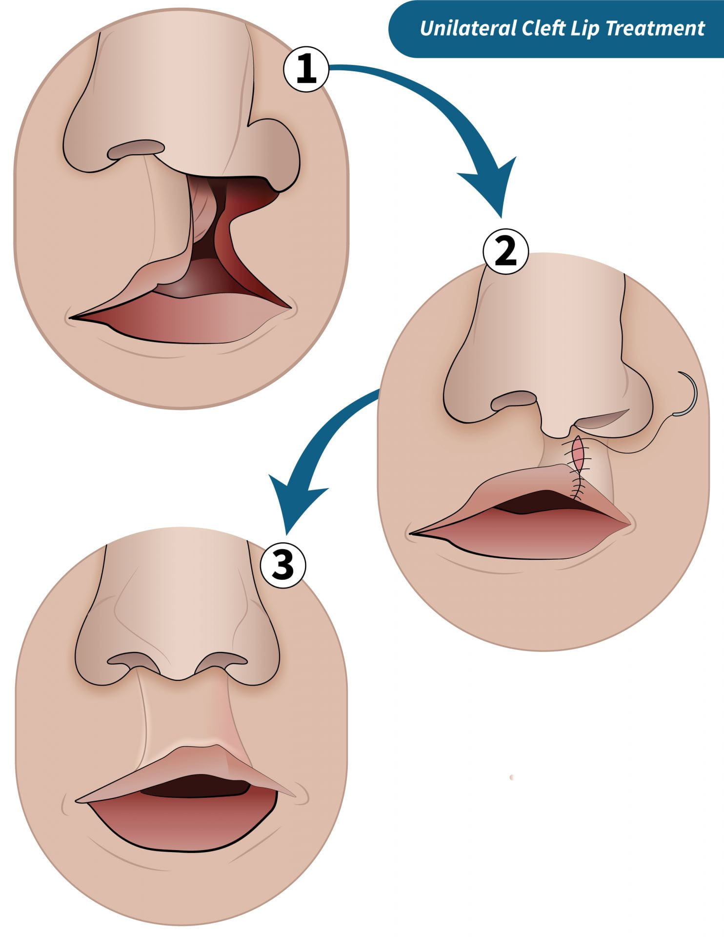 A Parents Guide To Cleft Lip And Cleft Palate Department Of Surgery