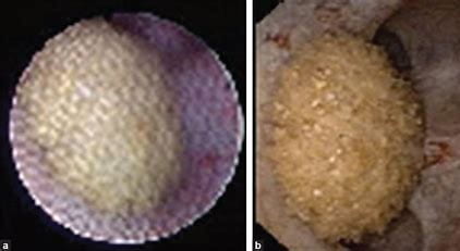 Ureteroscope images