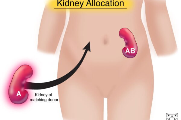 How Kidney Allocation Changed in 2021