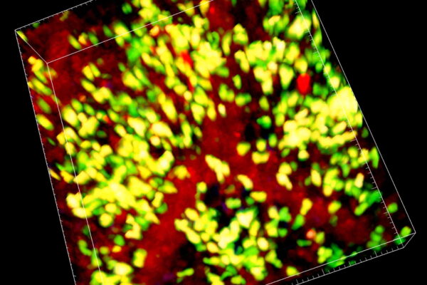 Identifying Causes of Vascular Damage in Lung Transplantation