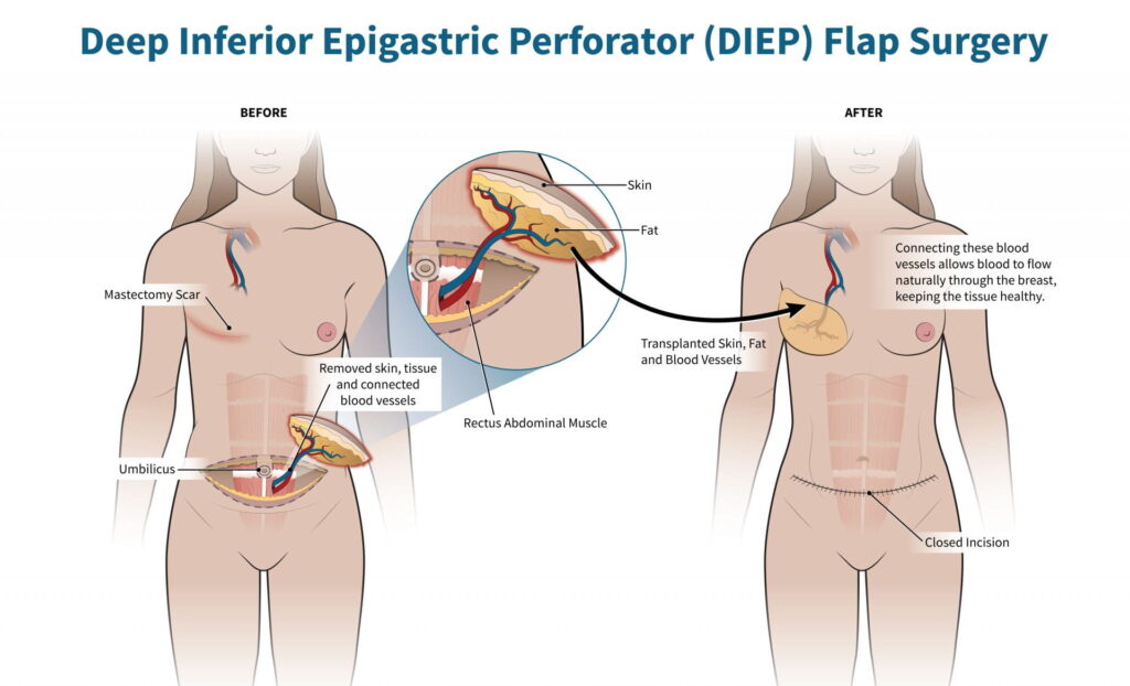 Medical illustration of DIEP flap surgery with skin, tissue and blood vessels removed from abdomen and transplanted to chest.