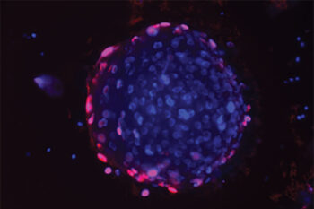 Human prostate cancer organoid