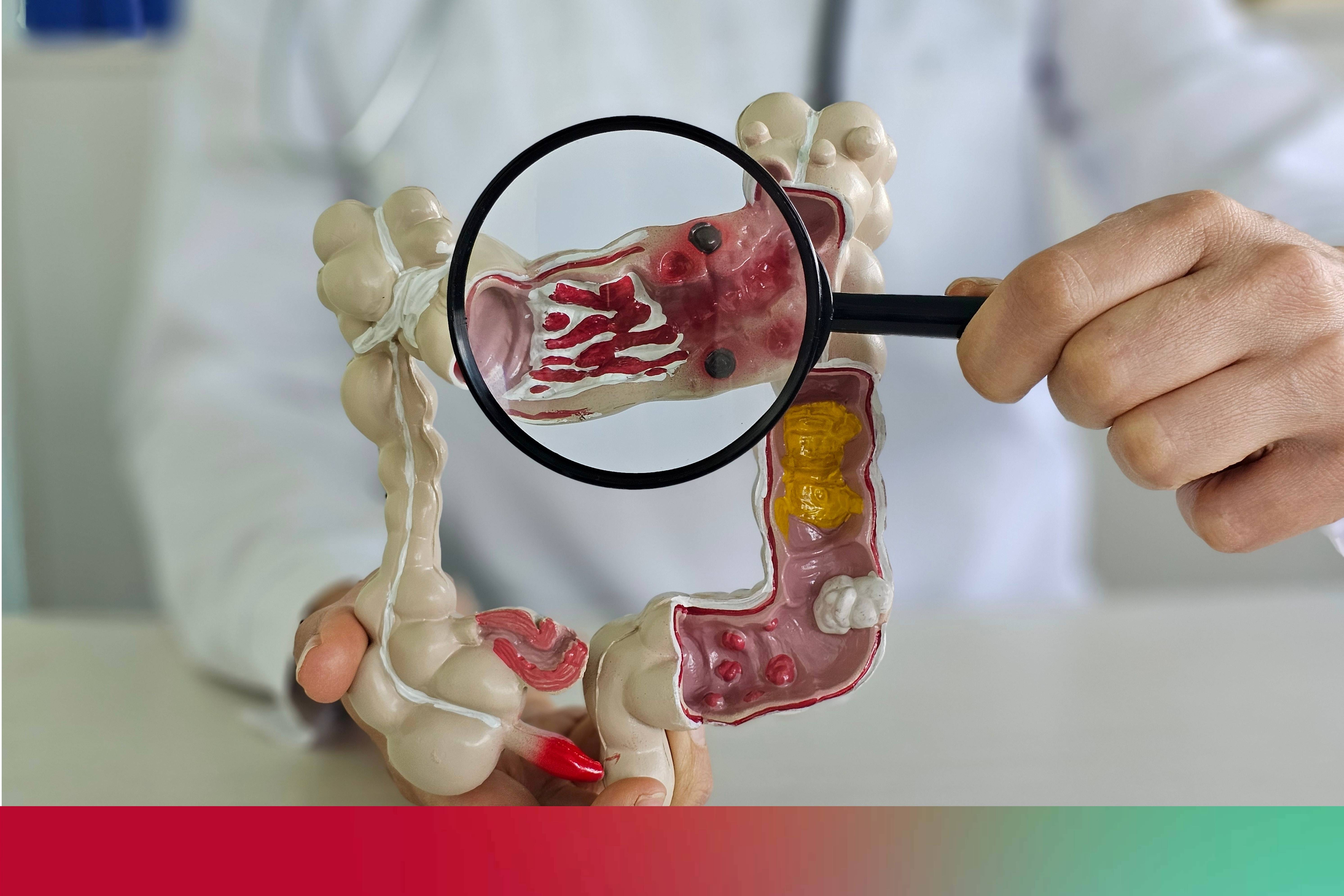 What is colorectal cancer? Signs, symptoms, and risk factors