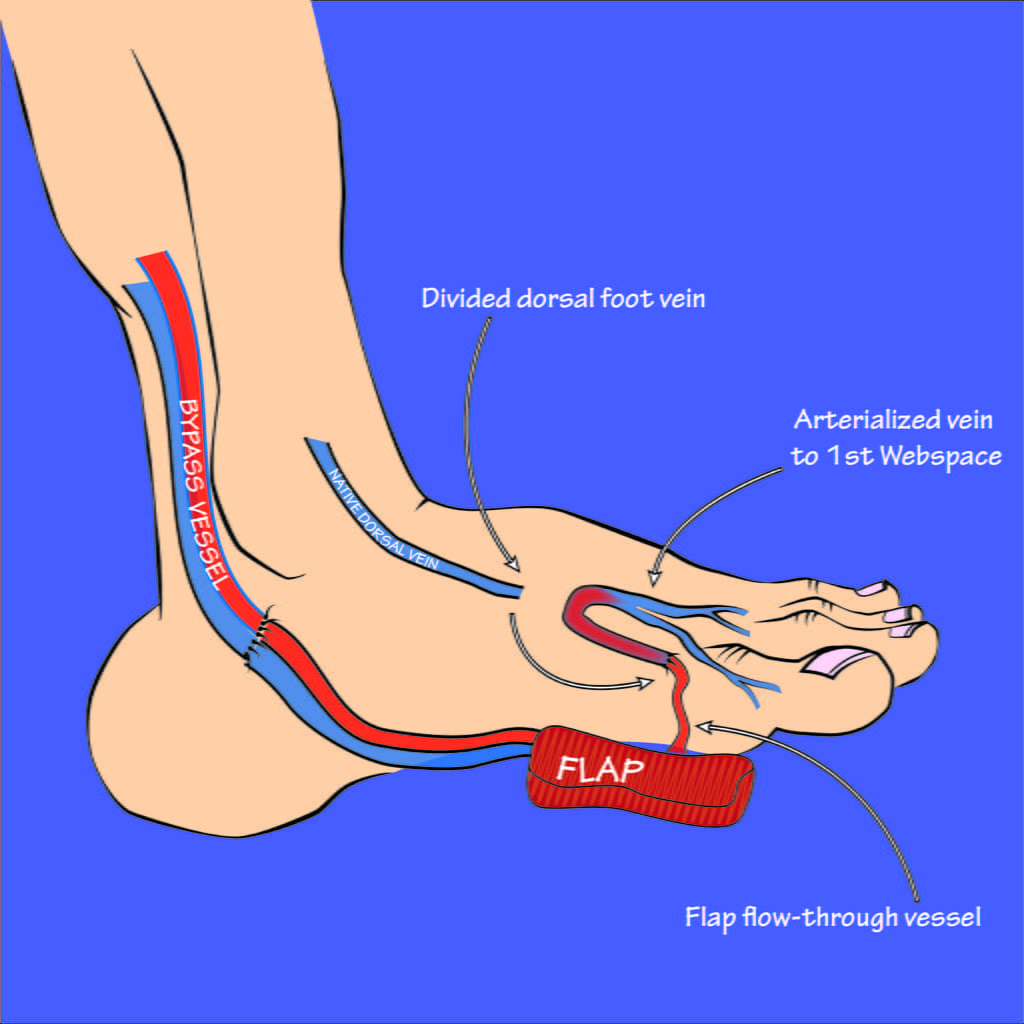Toe amputation: causes, surgery, recovery and complications