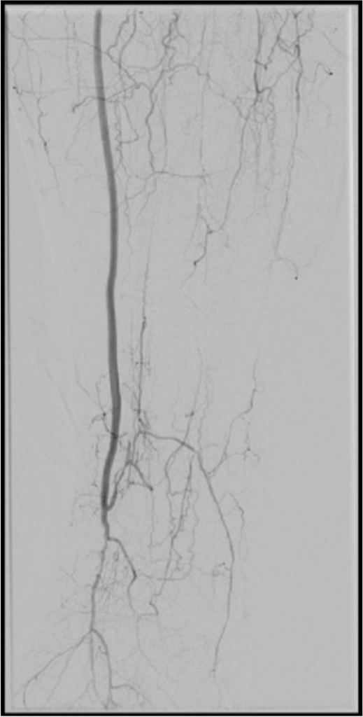 Picture from Julius Moss angiogram test.