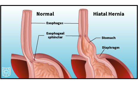 Illustration of the stomach and esophagus, showing normal anatomy compared to a hiatal hernia