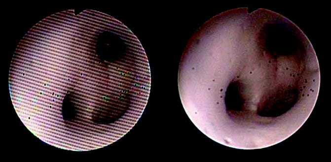 Ureteroscope image comparison