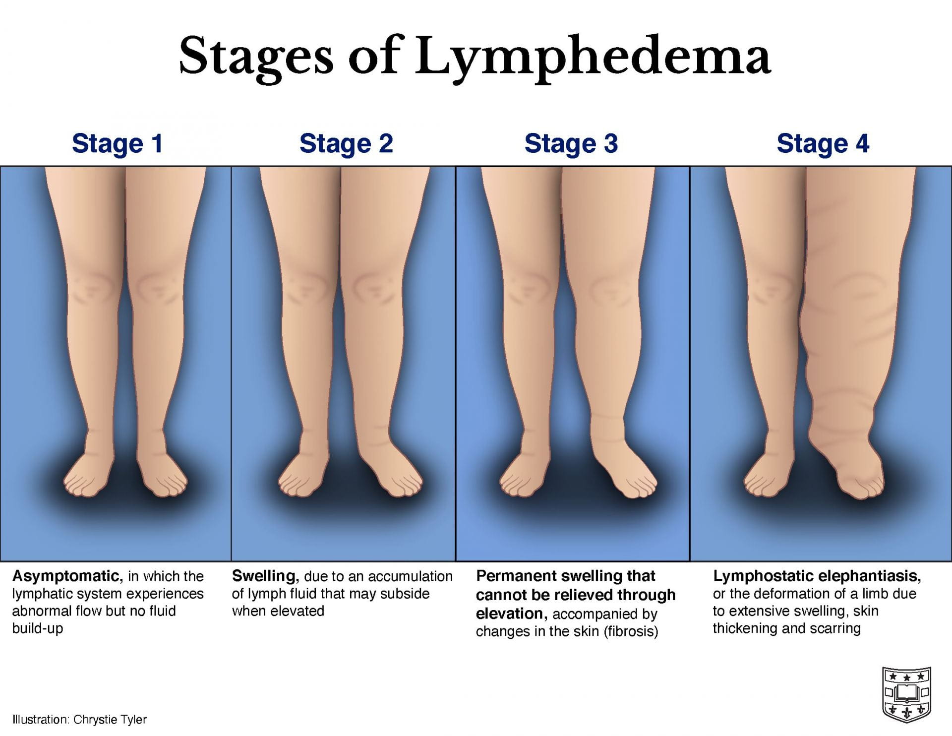 This image shows the progression of lymphedema. Four pairs of legs are placed side-by-side, with the labels stage 1, stage 2, stage 3, and stage 4. Stage 1 is asymptomatic, and shows no difference from a normal leg. As the disease progresses, the right leg becomes more and more swollen. At stage 3, there is permanent swelling of the limb as well as changes in the tissue known as fibrosis. Stage four is also known as lymphostatic elephantiasis. At this point, the limb is deformed due to swelling, skin thickening, and fibrosis. 