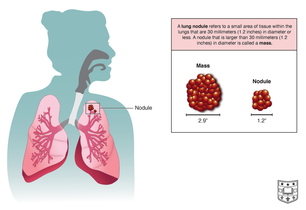 Ask the Doctors: Lung Nodules, Department of Surgery