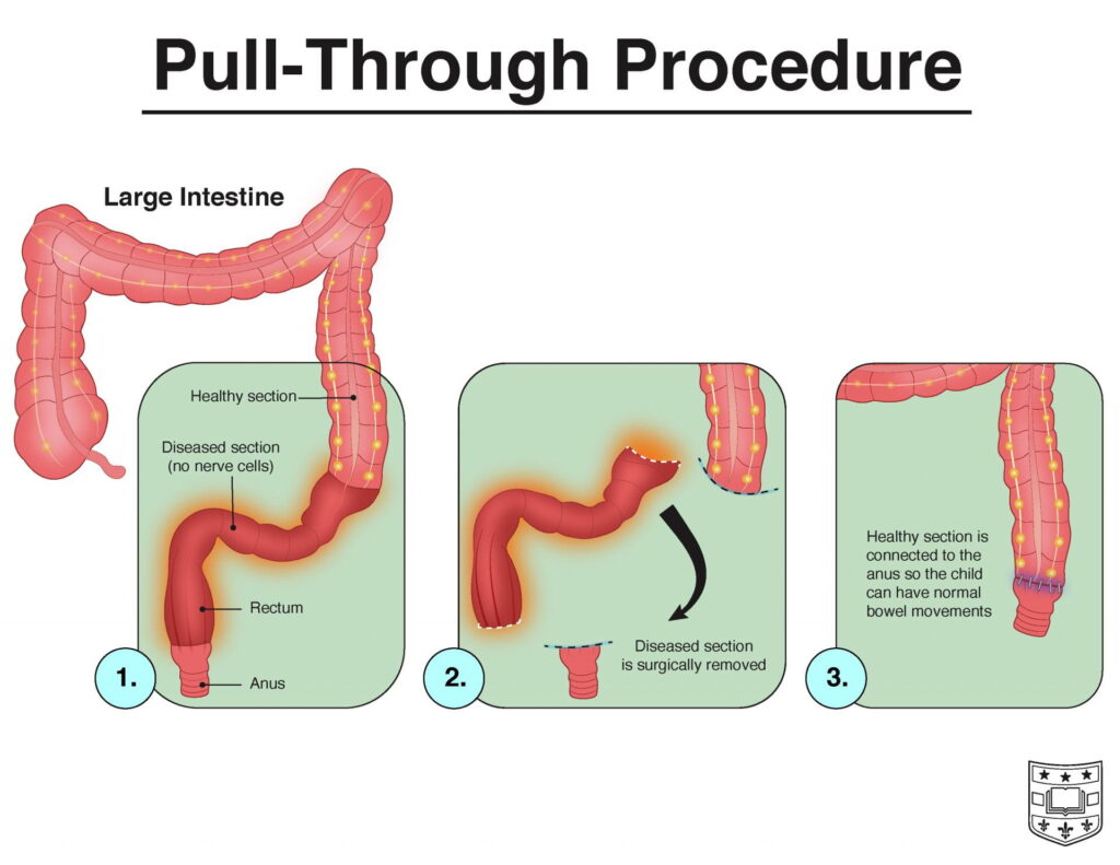 Illustration of pull-through procedure, showing the affected area of the colon that will be removed and extension of colon