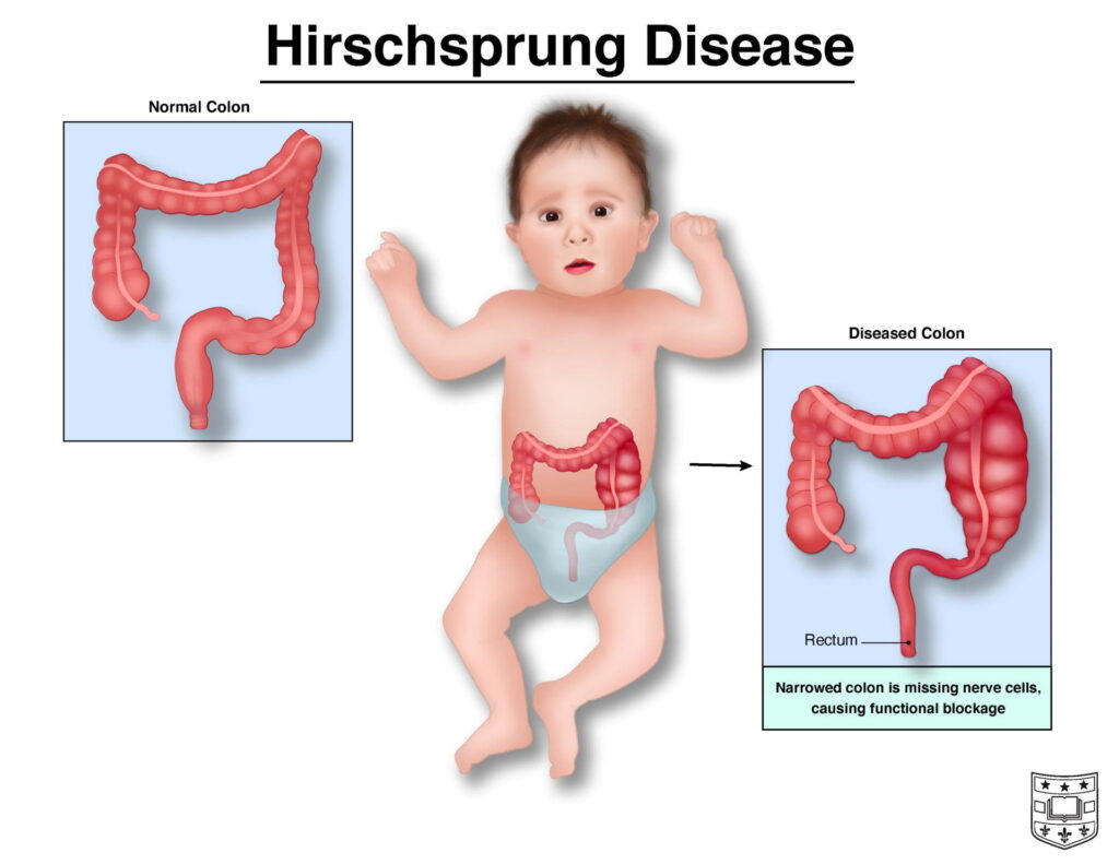 Illustration of infant with Hirschsprung disease, demonstrating difference between regular and affected colons
