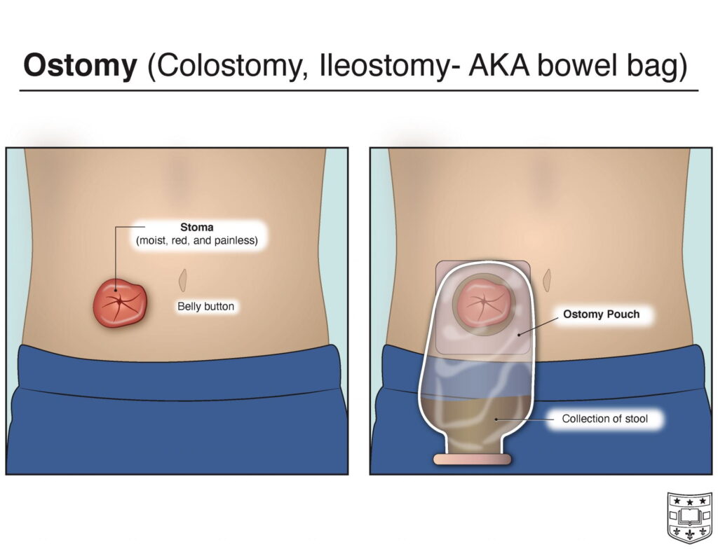 Illustrations of stoma, ostomy pouch, and function of ostomy for collecting stool