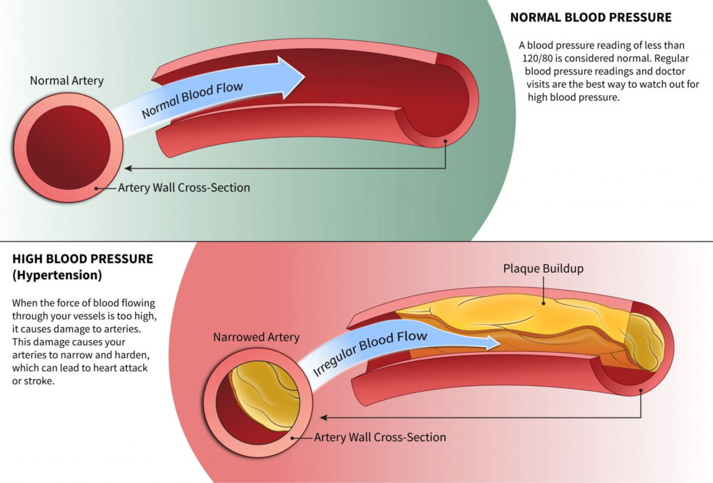 Healthy vessels with normal blood flow compared with damaged vessels affected by high blood pressure.