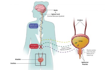 Problems with signals from the nervous system to the bladder cause neurogenic bladder.