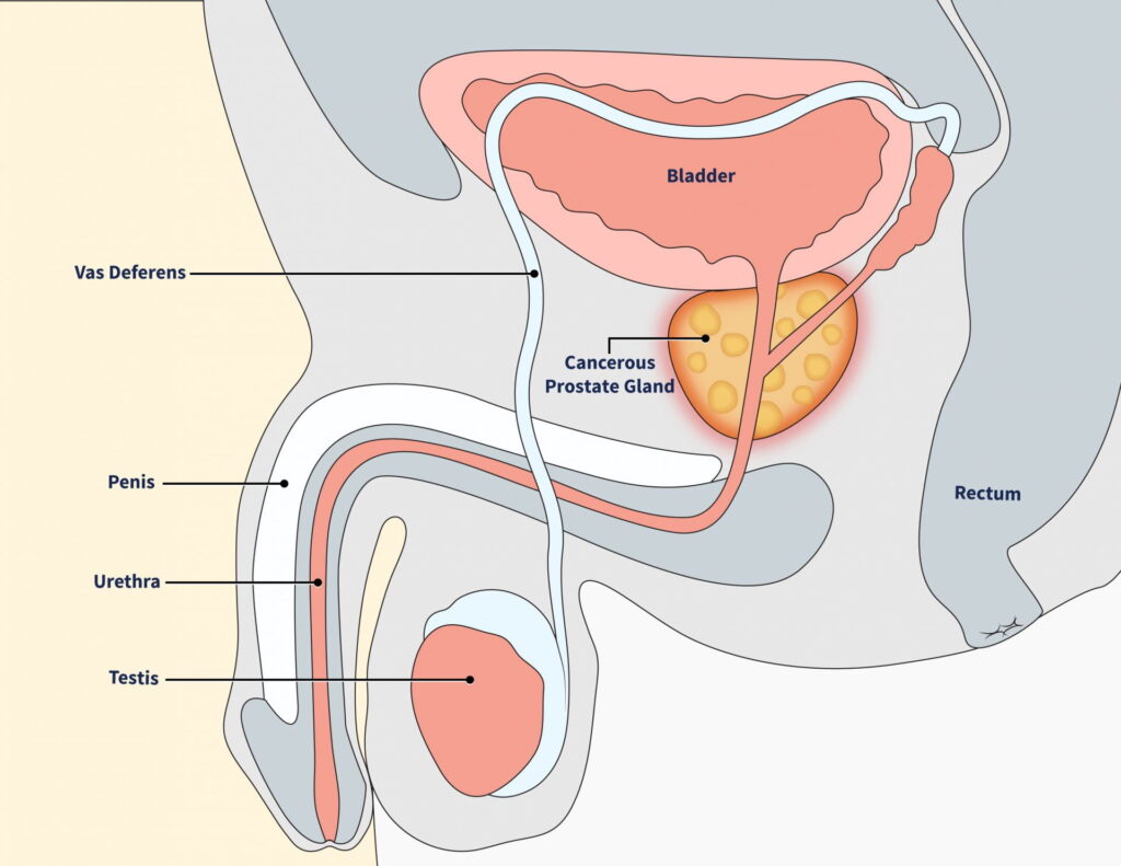 Cross section illustration of male reproductive system, prostate, bladder, and rectum. Cancerous prostate gland is highlighted.