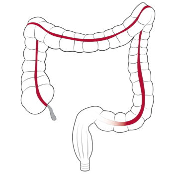 Section of Colon and Rectal Surgery
