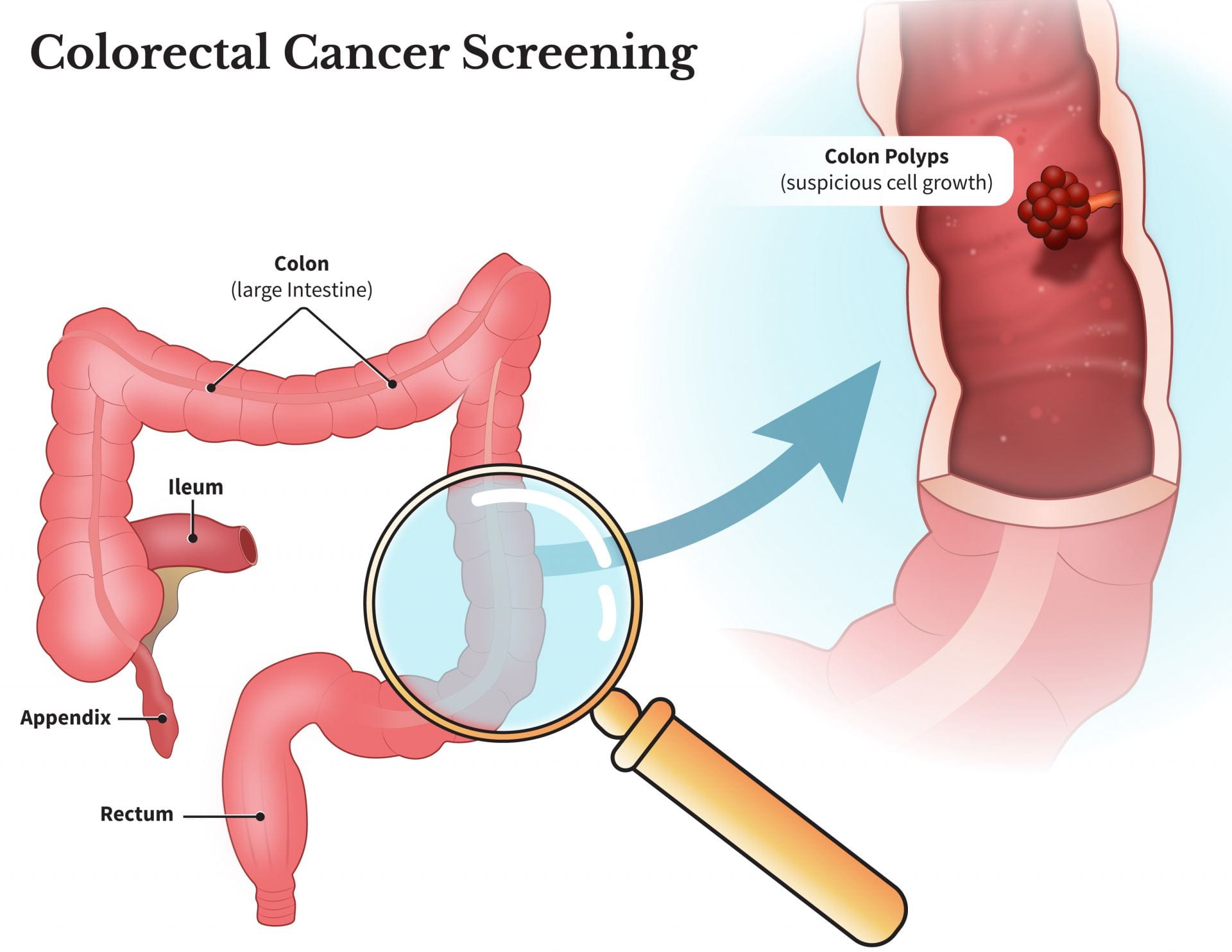 Who Is Eligible For Colorectal Cancer Screening In 2022 Department