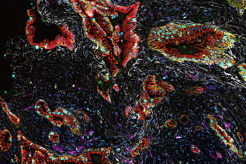 Pancreatic tumor cell imaging