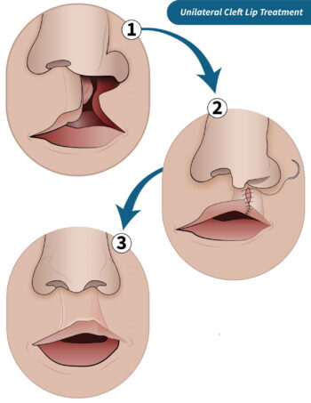 A Parent’s Guide to Cleft Lip and Cleft Palate | Department of Surgery ...