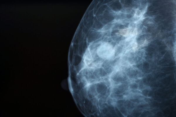 Change in breast density over time linked to cancer risk
